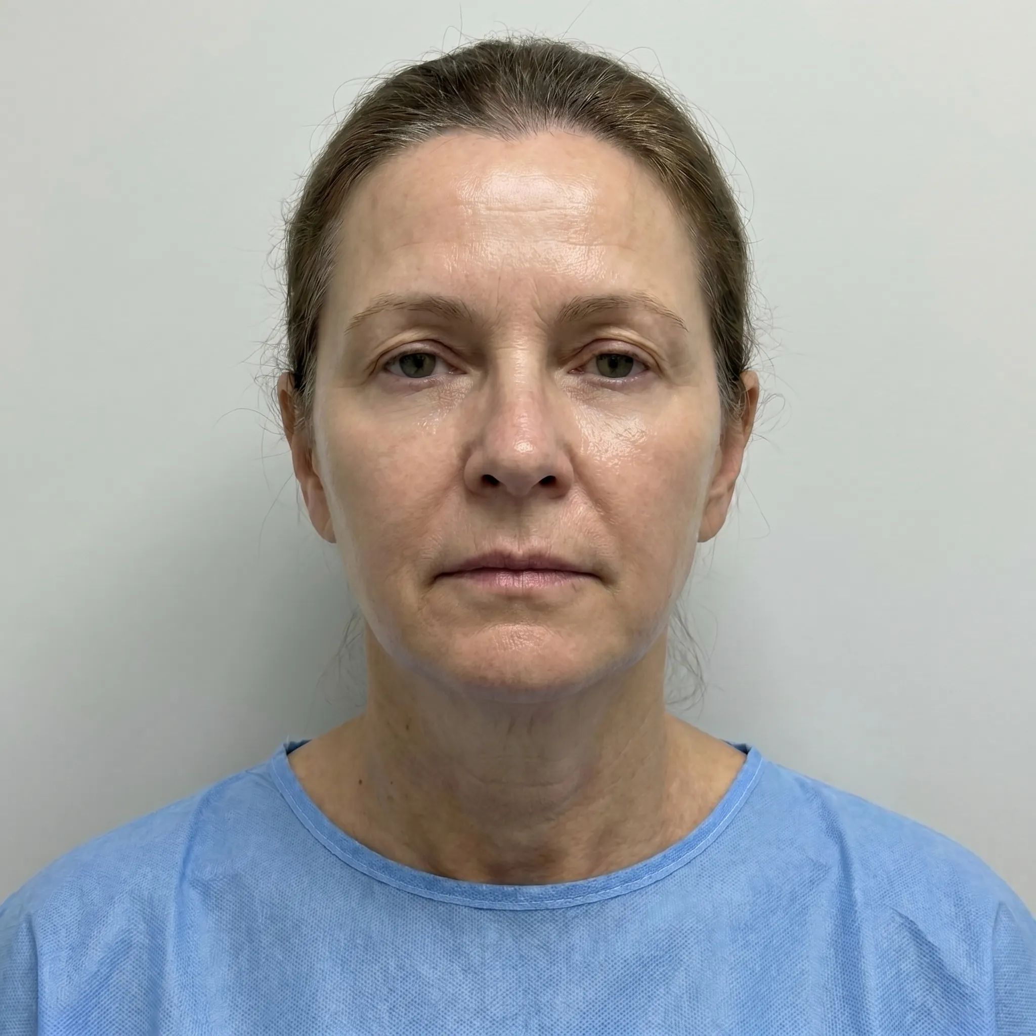 Facial rejuvenation 12 weeks post-operative outcome